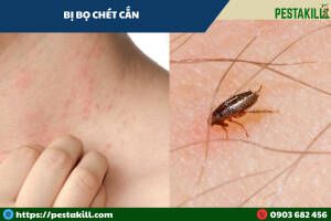dấu vết bị bọ chét cắn