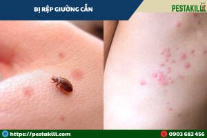 dấu vết rệp giường cắn
