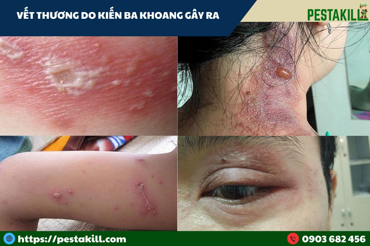 dấu vết thương kiến ba khoang gây ra